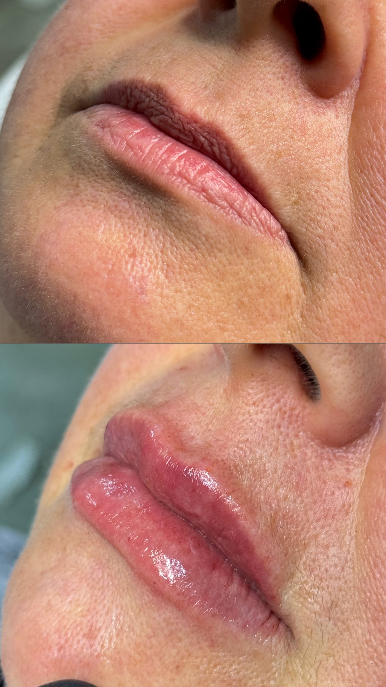 Preenchimento Facial